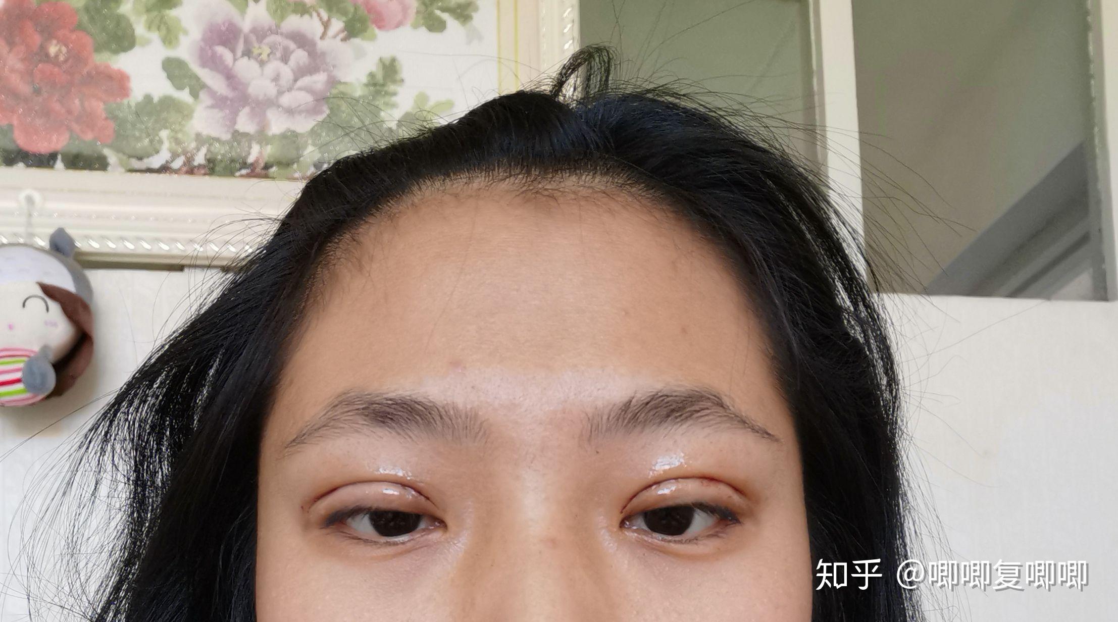 三点定位双眼皮记录