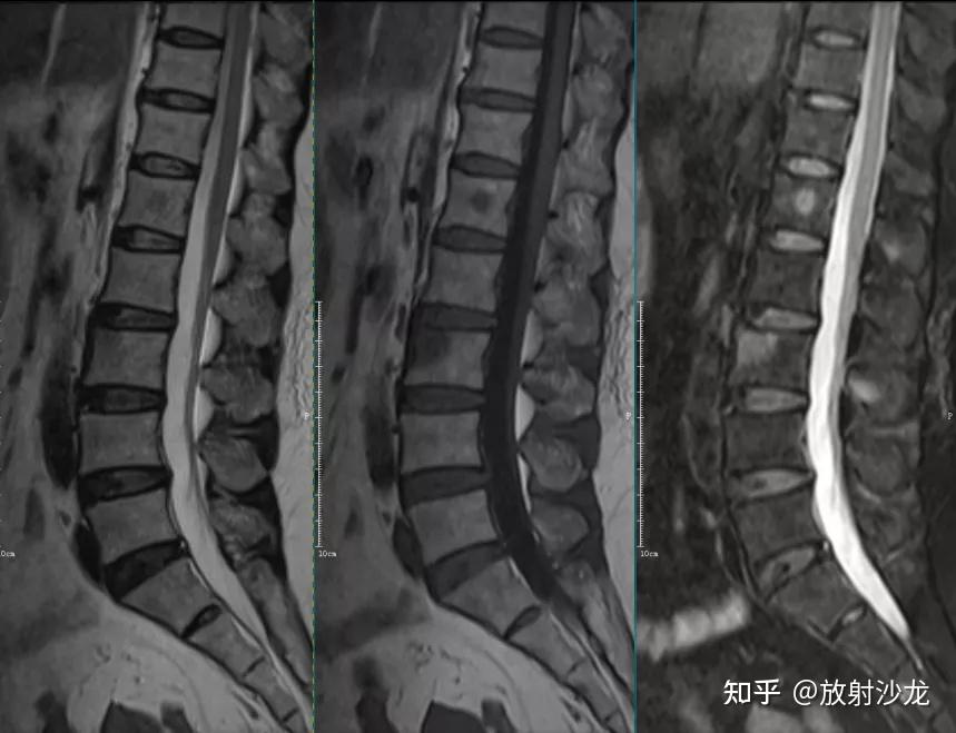 椎体终板炎 | 发生机制、分型以及 MRI 表现 - 知乎