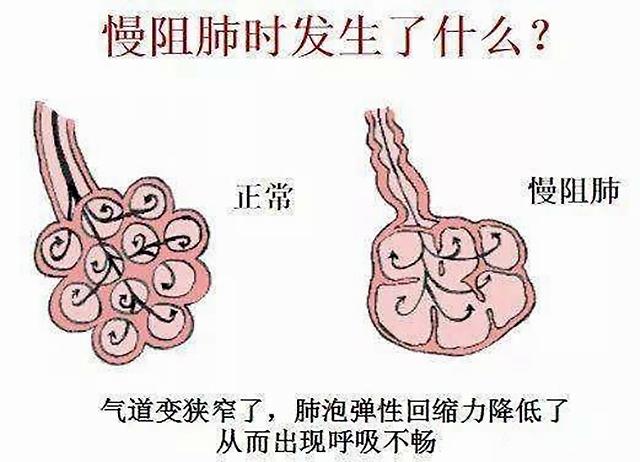 但由于阻塞性肺气肿,肺泡弹性纤维断裂,肺泡过度膨胀不可以回缩,肺里