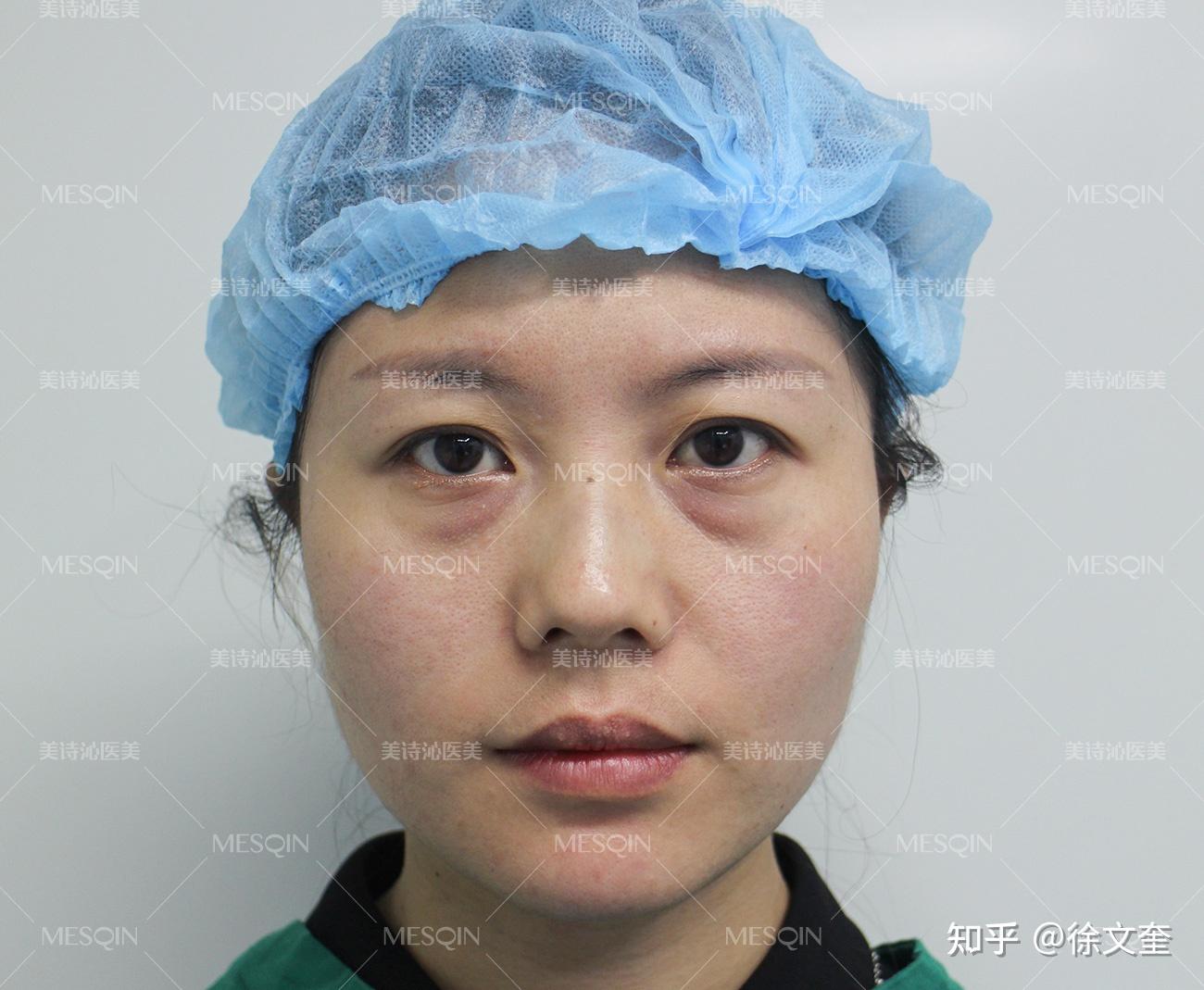 郭鑫医生眼袋手术案例二：外切眼袋去除术（下眼睑除皱） - 好大夫在线
