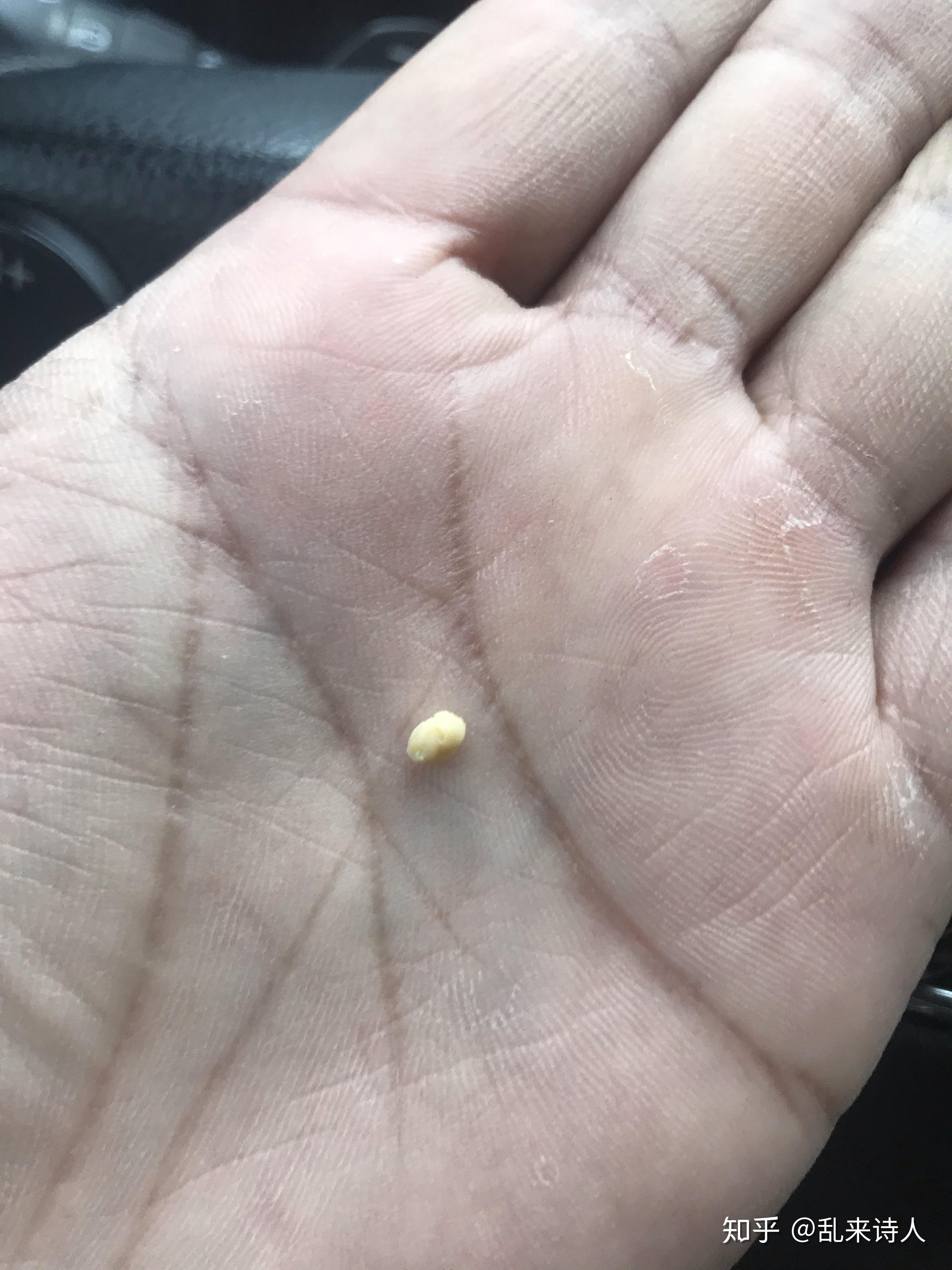 隐窝结石到底有多臭!