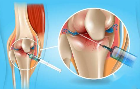 海南优尼科尔干细胞治疗退行性关节炎新进展
