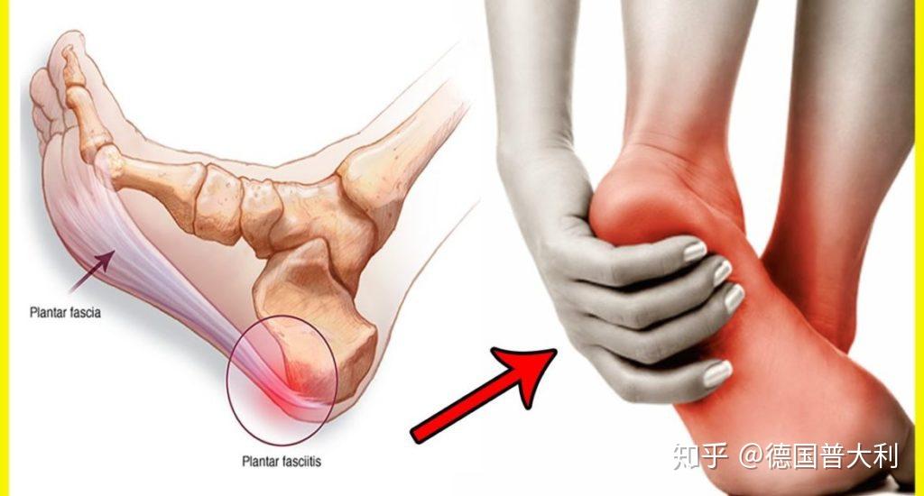 怎麼區分足底筋膜炎和跟腱炎