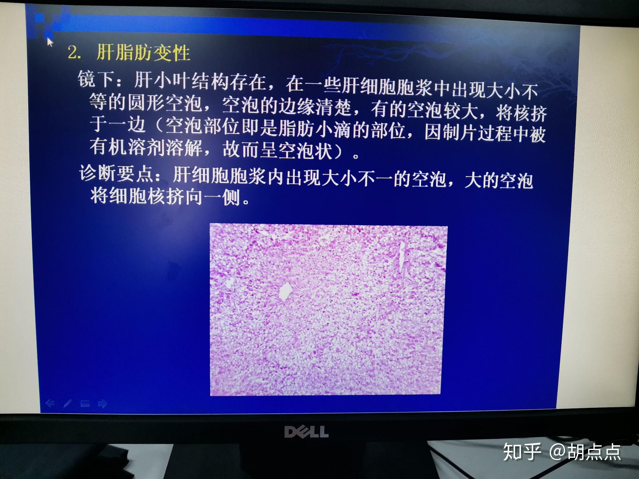 肝脂肪變性腎近曲小管上皮細胞水腫27 人贊同了該文章卑微護理學姐