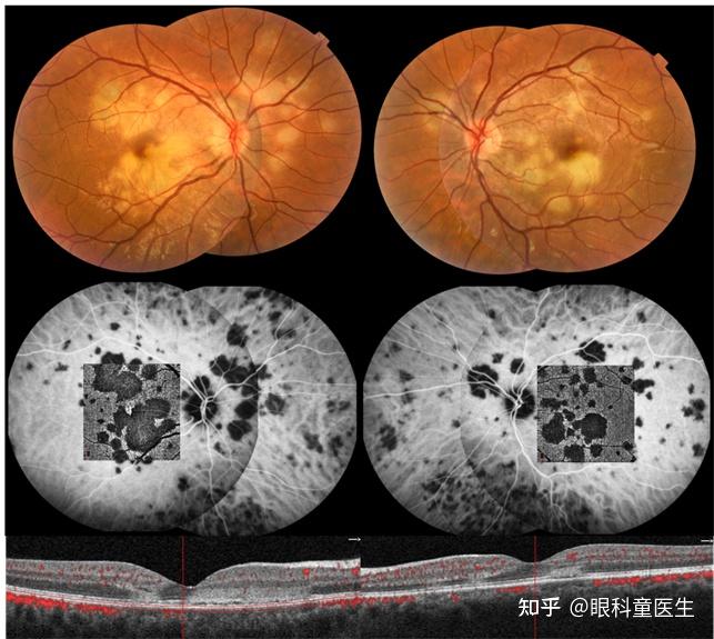 后葡萄膜炎13匍行性脉络膜炎