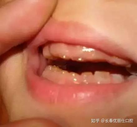 惨小孩1月内牙齿全部掉光只因爸妈不注意这件事情