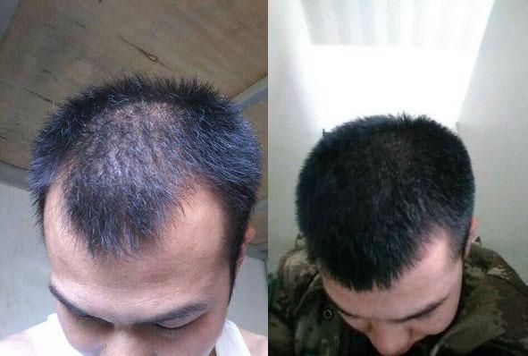 脱发严重怎么办中年人千万要记住这些