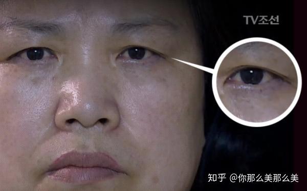 菲斯莱茵切眉术让你拥有更年轻 更有神的眼眉 知乎