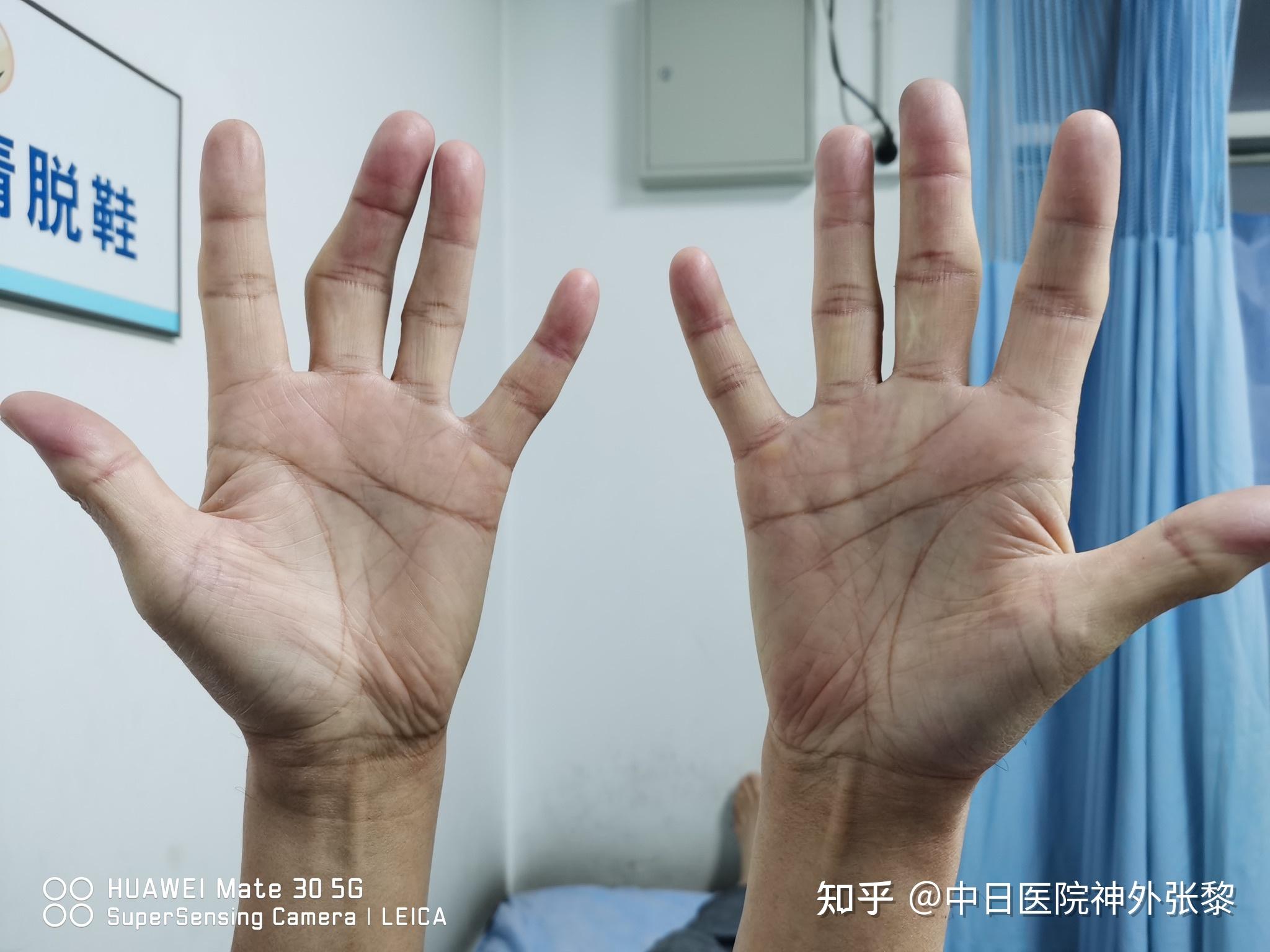 拇指关节和手指关节肌肉失衡_患者