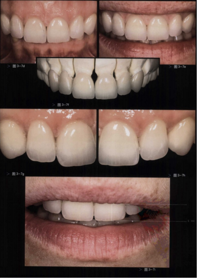 广州种植牙|口腔美学修复中的唇齿关系分析——这样才是好看又好用的