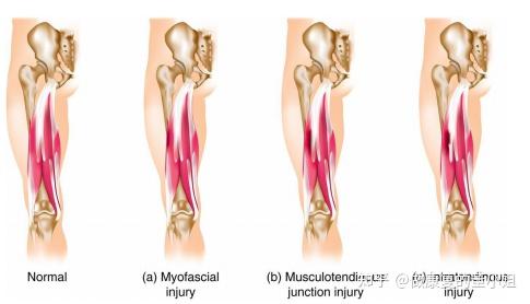 大腿后侧腘绳肌损伤的治疗原则文末配训练视频