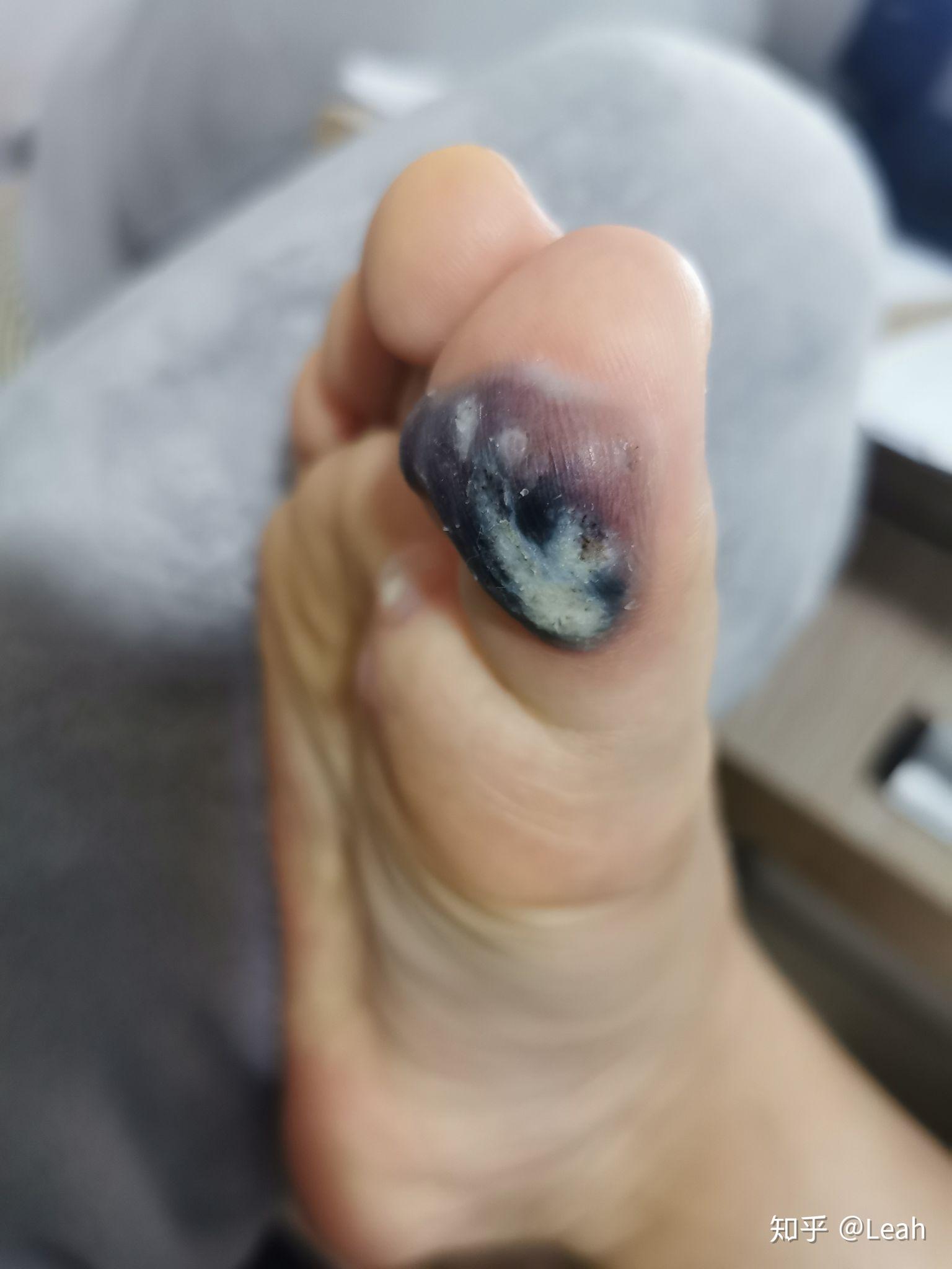 阿司匹林治跖疣有图慎入