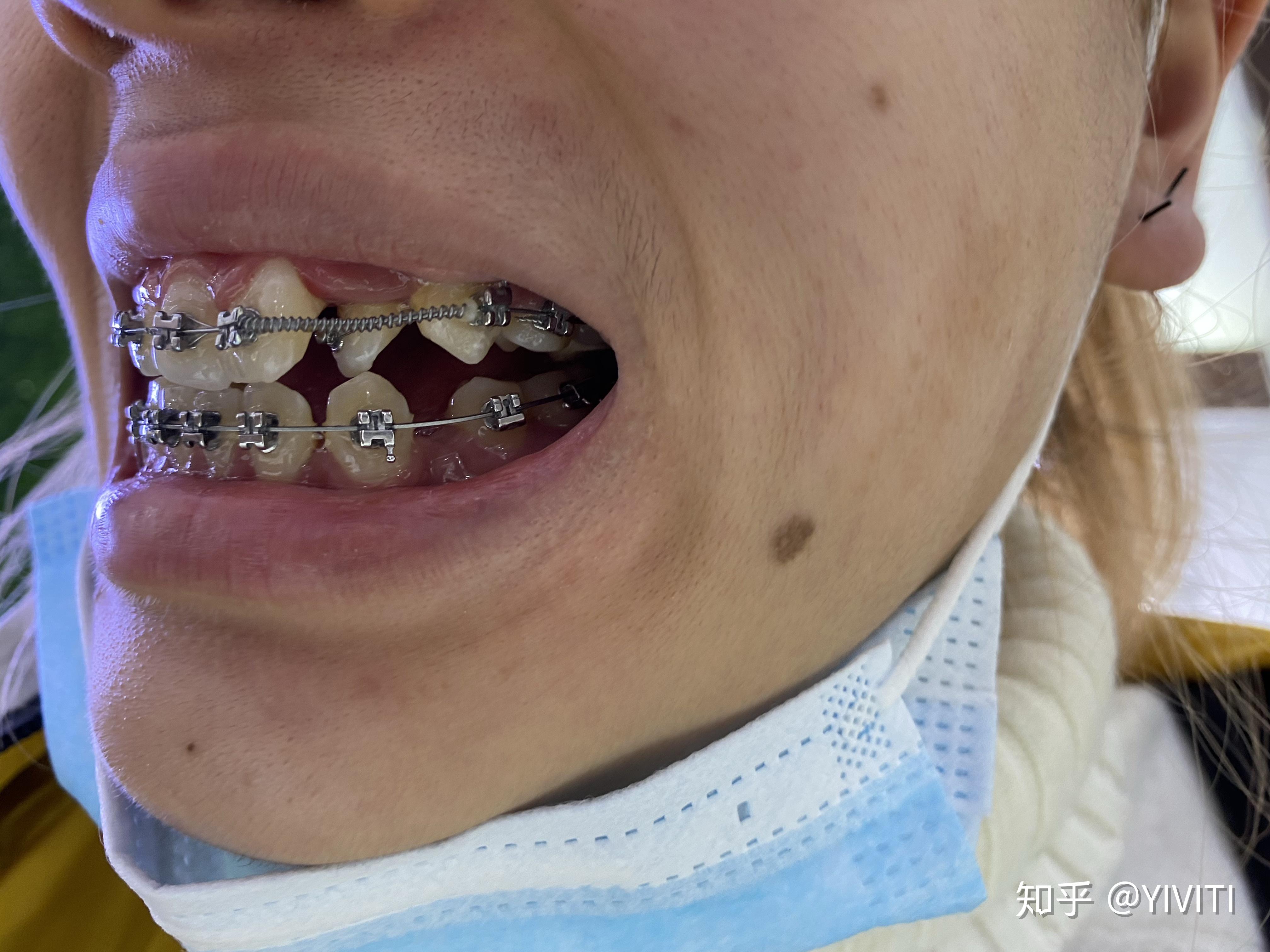 错牙合畸形，如何区分是骨性、牙性还是功能性？_深圳爱康健口腔医院(官网)