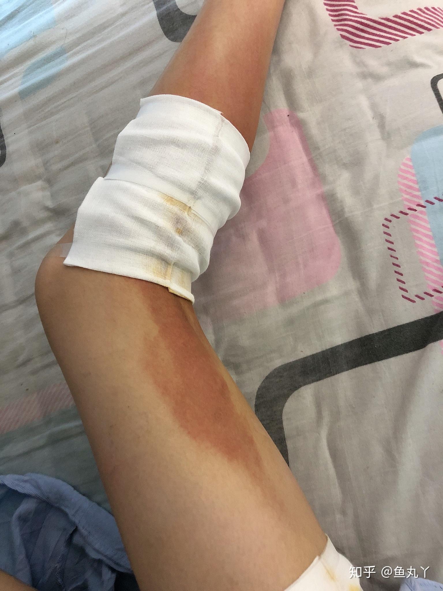 被刚煮沸的开水烫伤浅二度烫伤的恢复过程