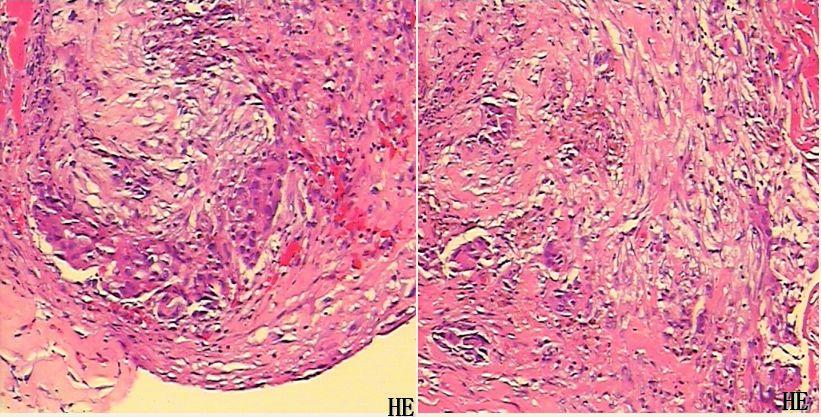 肺癌病例73岁晚期肺腺癌生存期接近4年