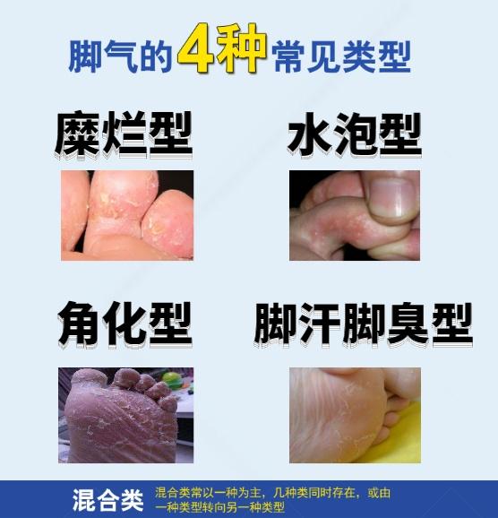 脚气的4种类型和10种级别来对号入座啦