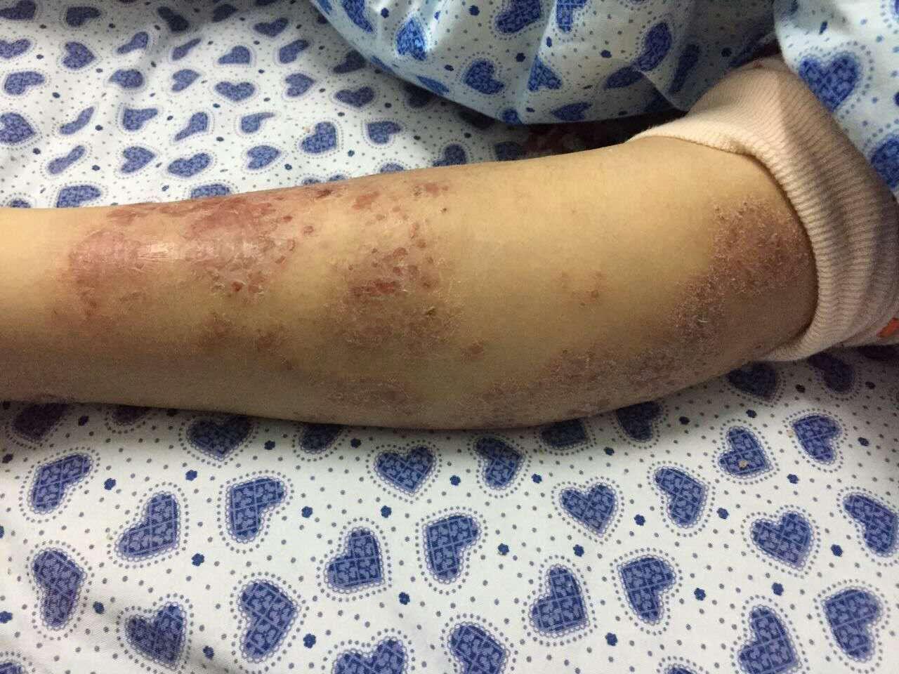 以下是来时身上病况的照片:小客户10岁,全身长满红疮,白天身上淌黄水