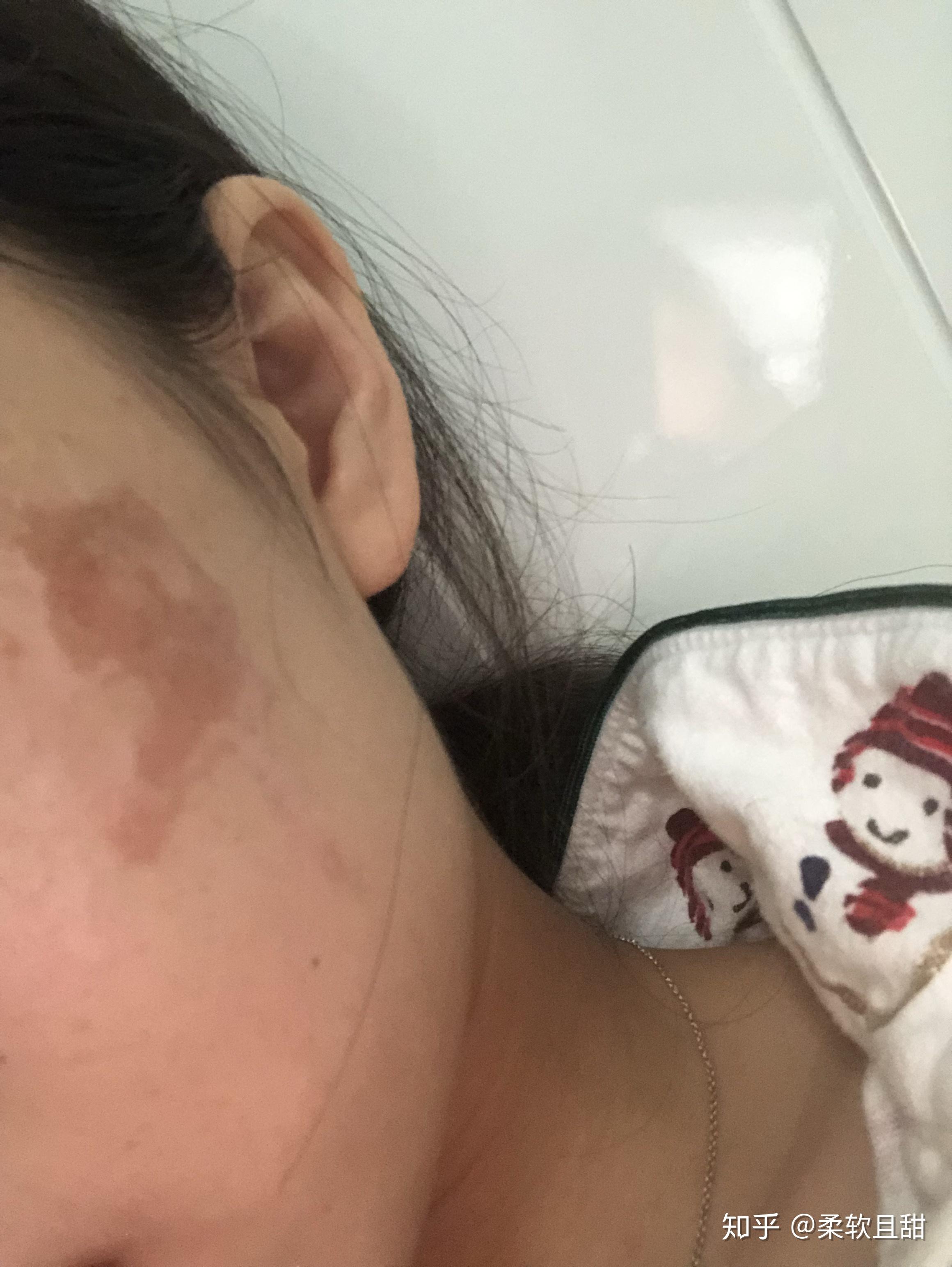 烫伤后色素沉淀