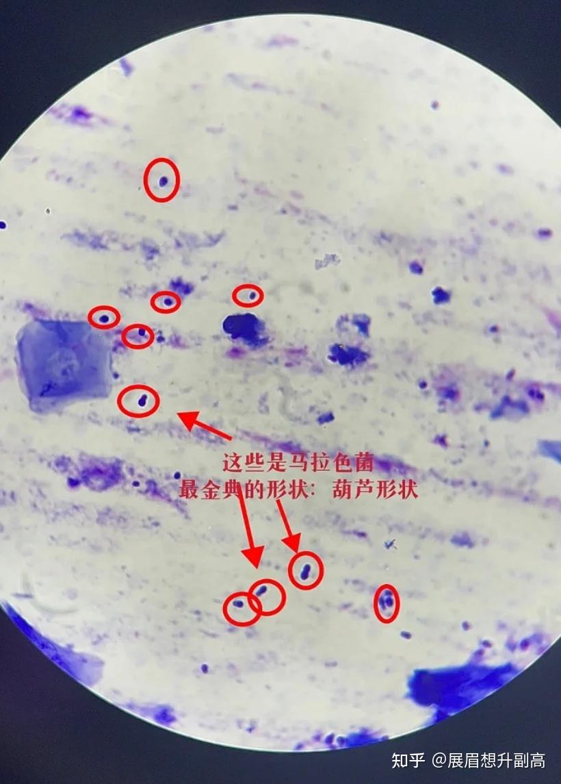 头皮真菌镜检图片