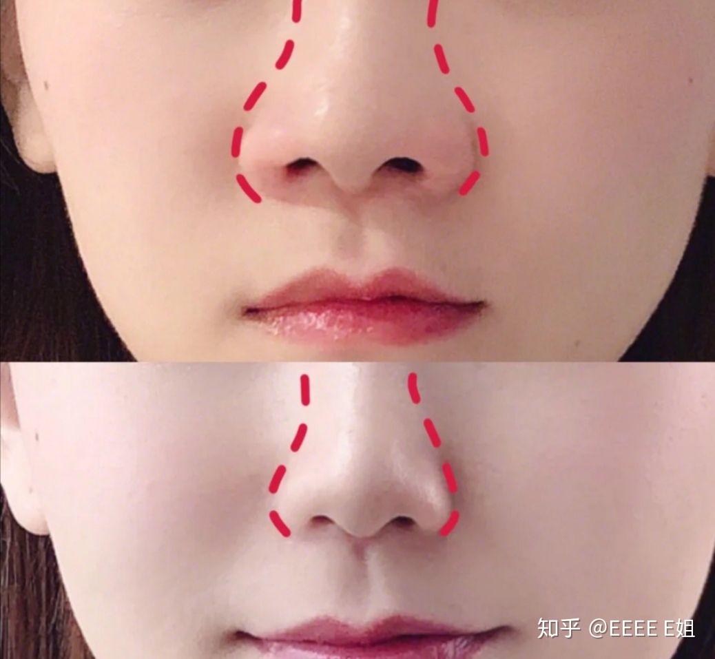 隆鼻手术有哪些种类? | Erufu Care