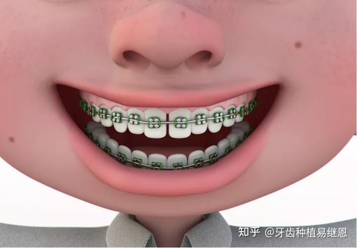 需要根据每个人的牙齿实际情况进行判断,比如牙齿的拥挤程度,牙槽骨量