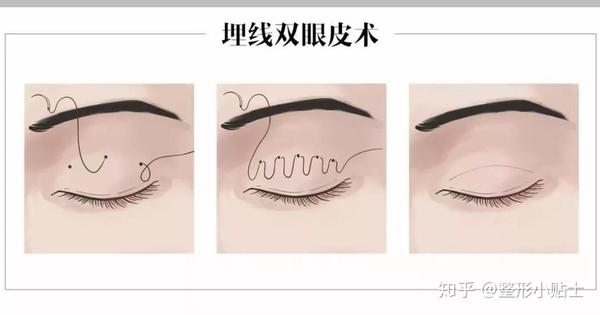 双眼皮价格表图片_郑大一附院割双眼皮价格_双眼皮的价格
