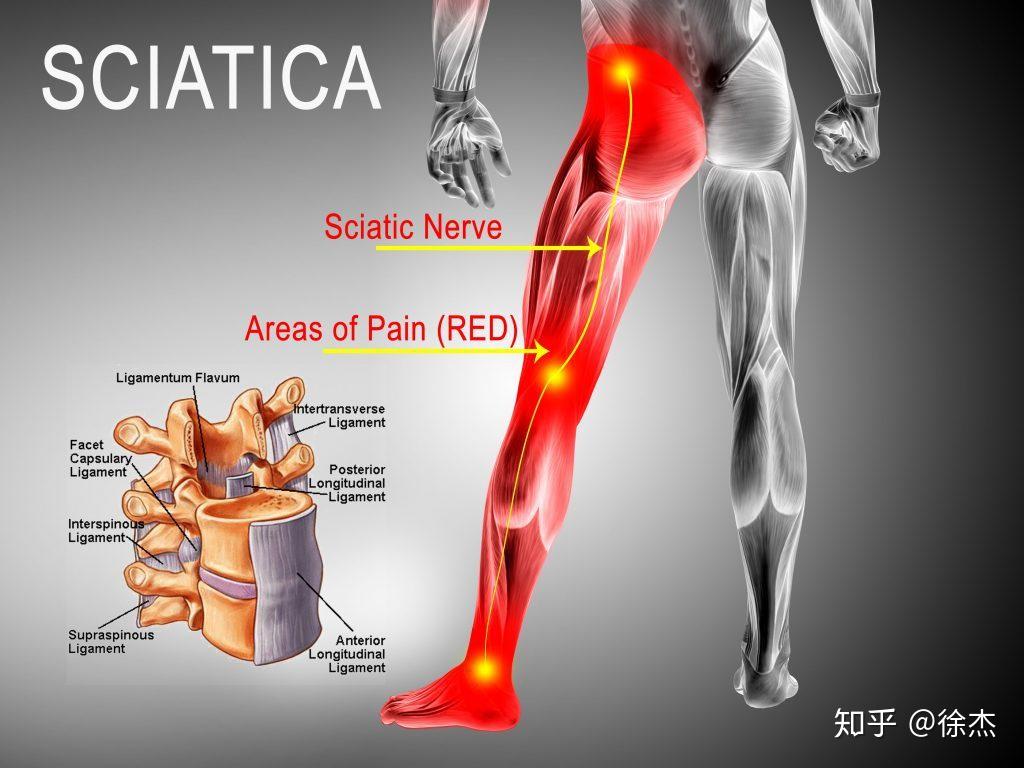 pin-on-sciatica