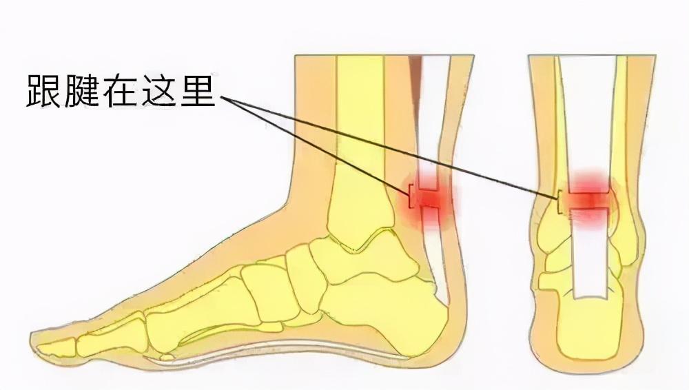 幾乎直接決定了小腿肌肉的分佈和形態,也就是說小腿部位的跟腱是影響