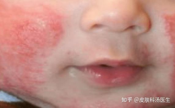 什么是特应性皮炎。特应性皮炎发病的原因是 - 知乎