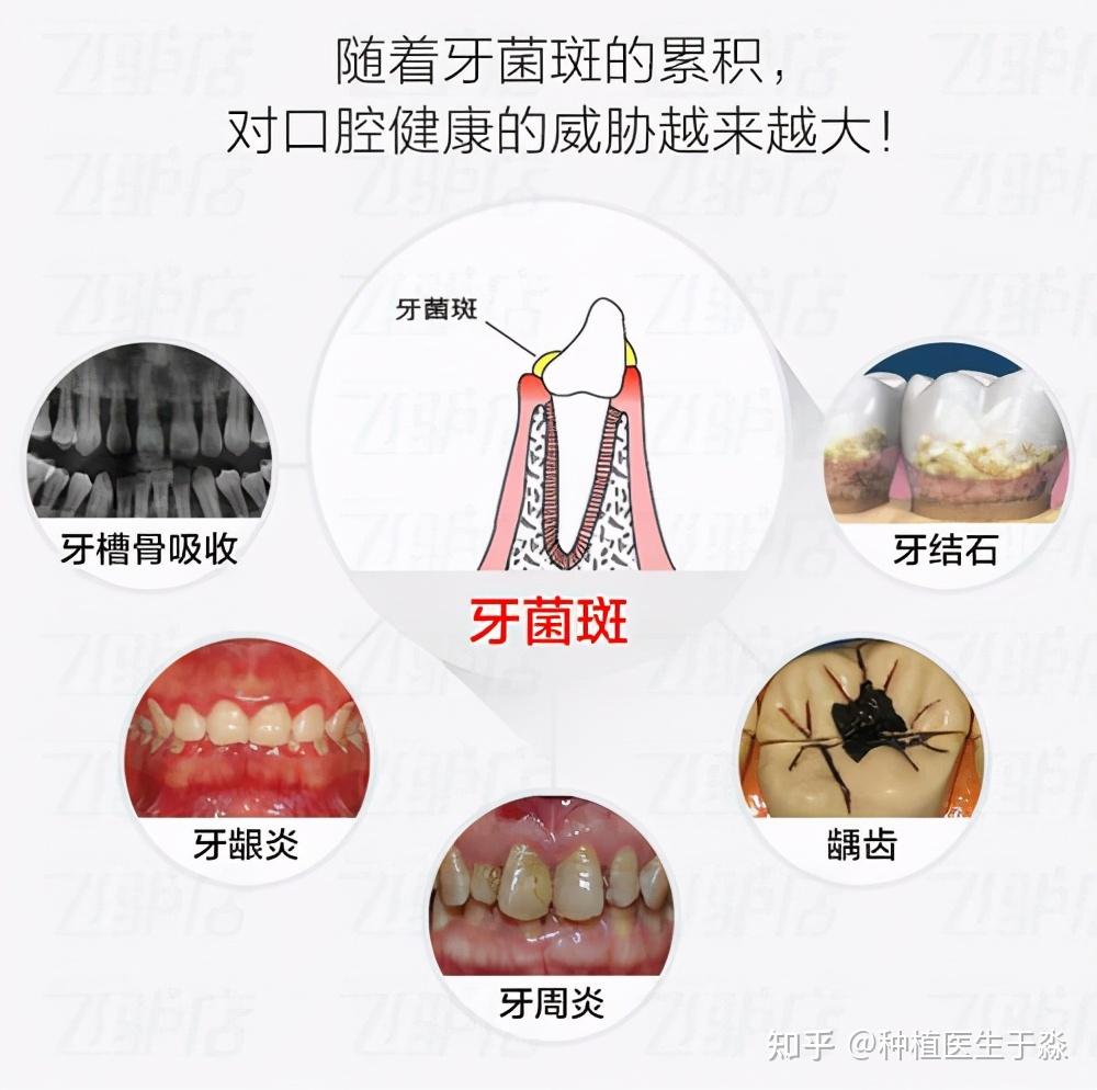 牙菌斑很顽固,不及时清除,你的牙就没了!