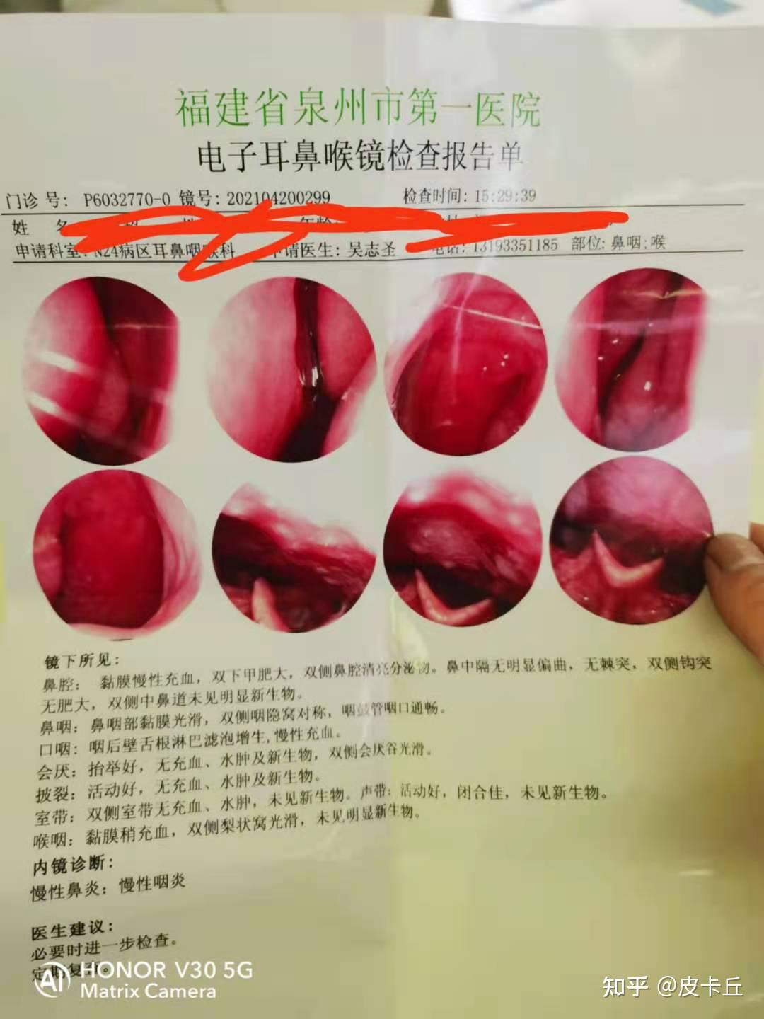 口气口臭的治疗方案《本人亲测》 - 知乎