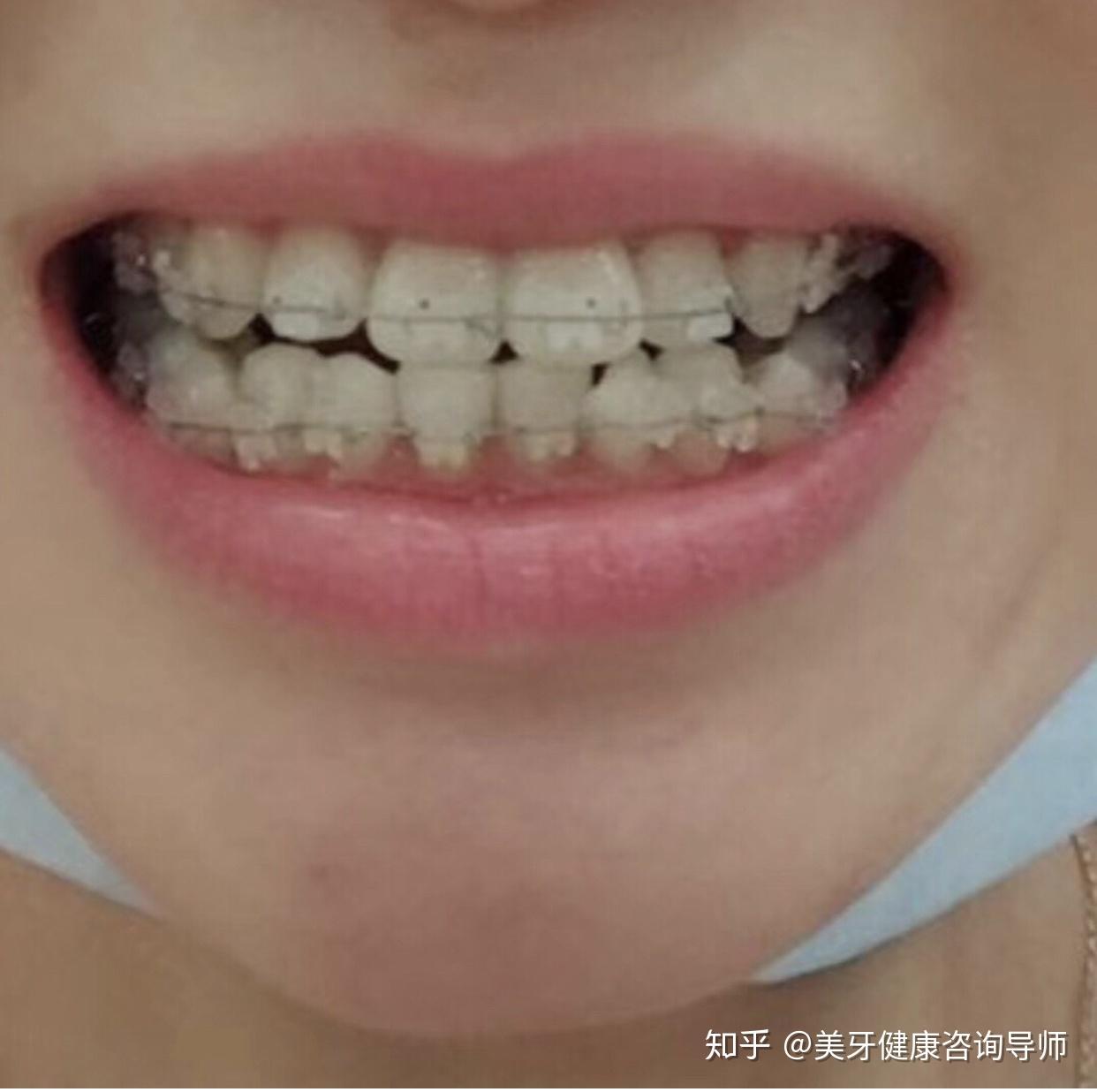 冰晶半隐形矫正在无形中悄悄的变美