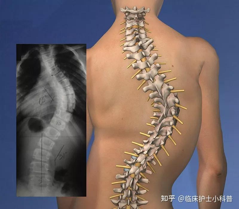 脊柱变形易导致肩背部,腰部顽固性疼痛,严重者甚至出现神经受损,神经