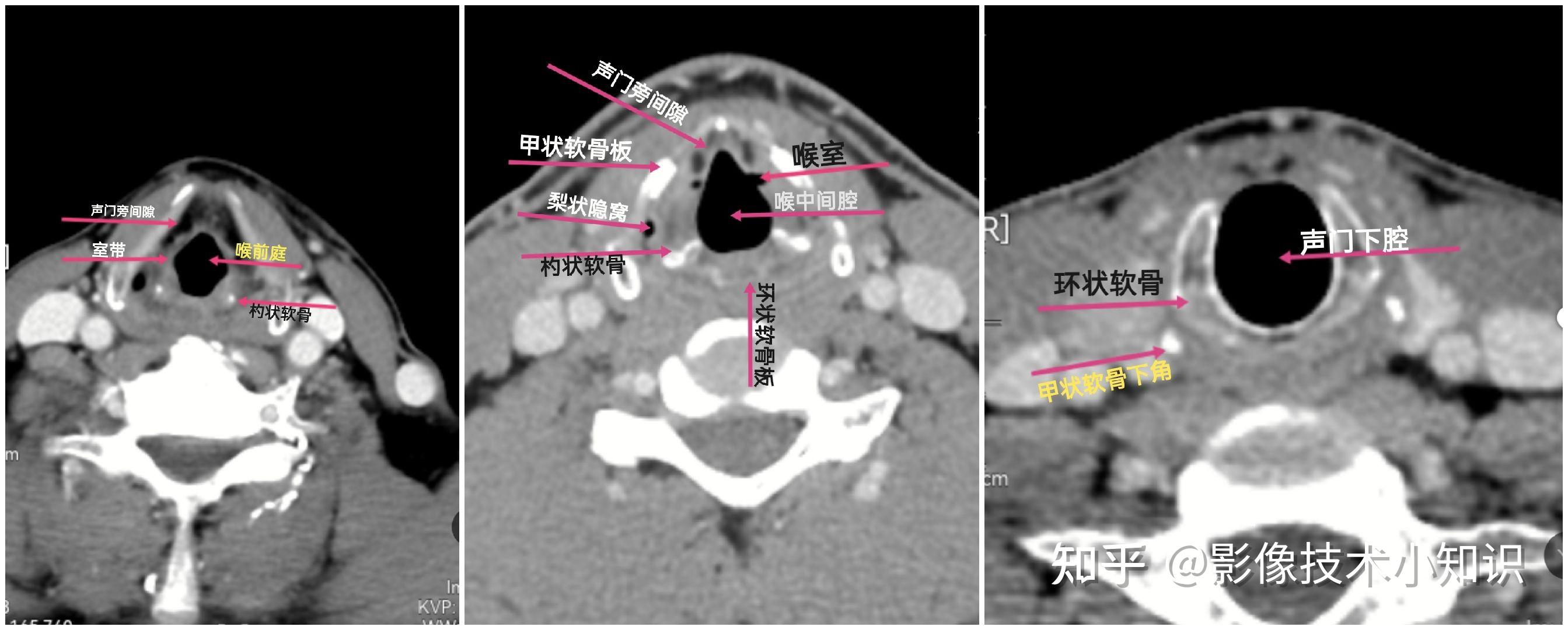 声门CT图片