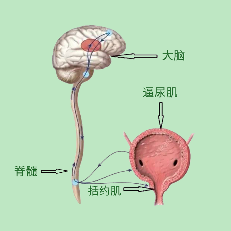 尿失禁尿潴留小心神经源性膀胱