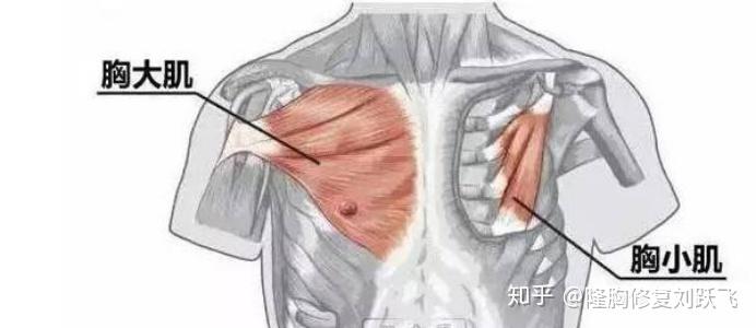 假体隆胸能做出乳沟吗?效果好吗?自然吗? - 知乎
