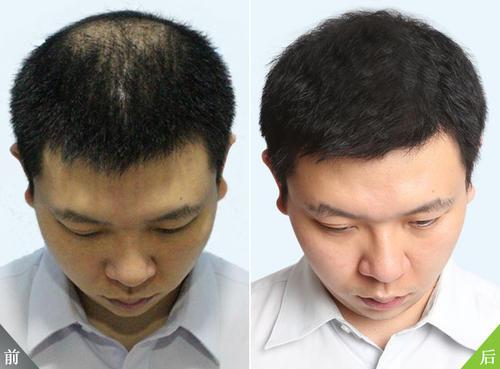 什么能生发养发？真实客户案例，分享生发最有效的方法！ - 知乎