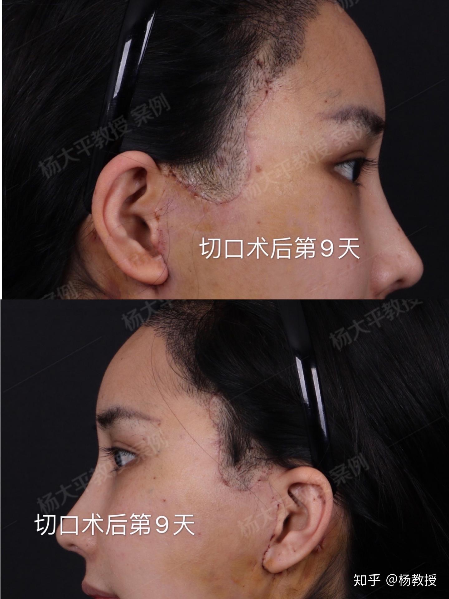 切口的位置影响术后瘢痕的恢复效果 - 知乎