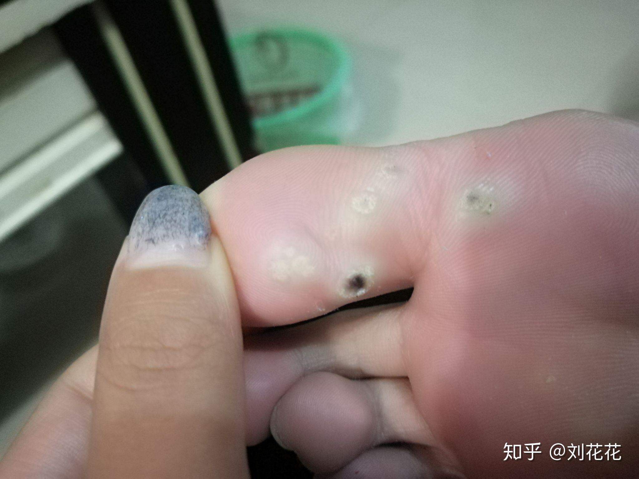 请问这是什么疣怎么治