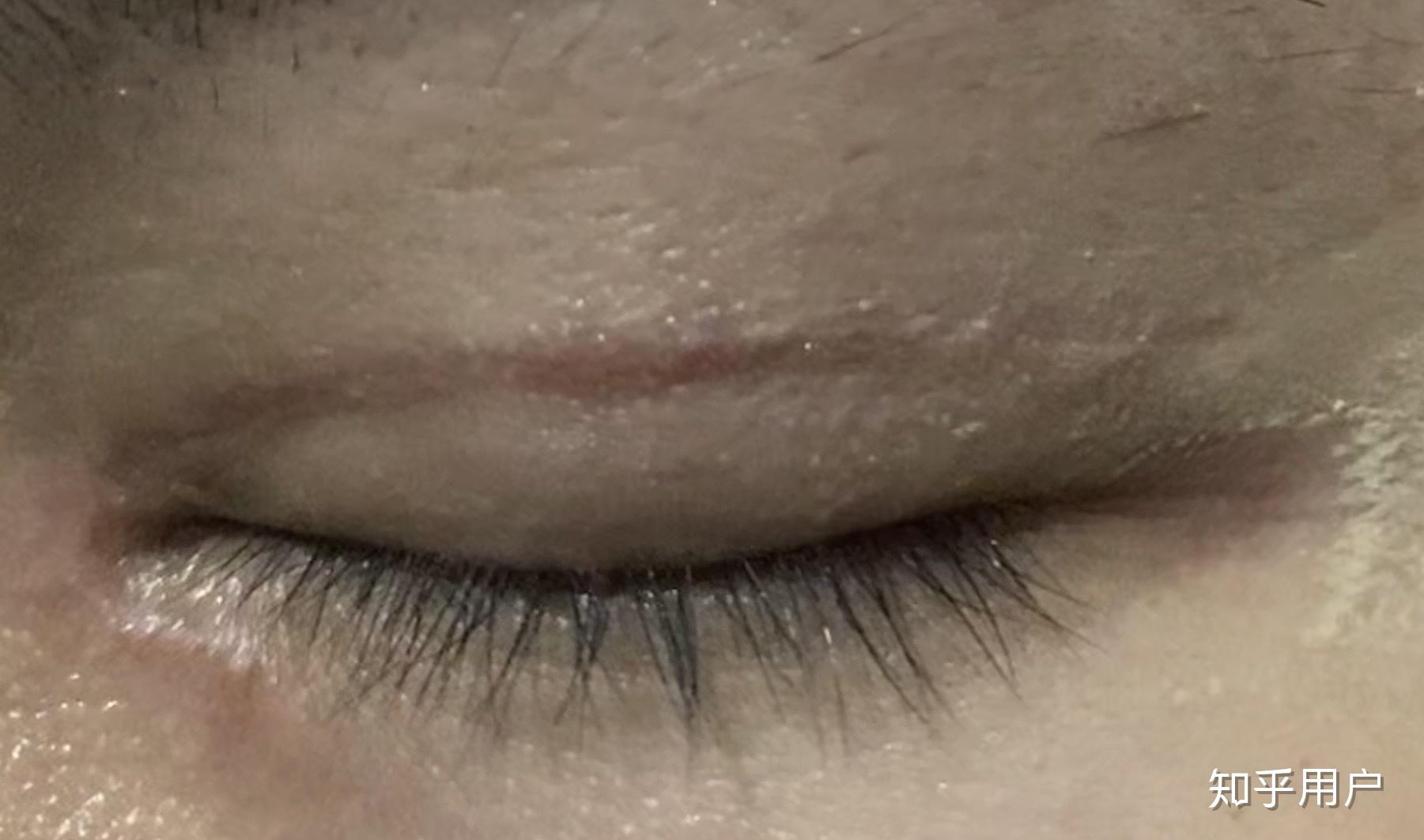 双眼皮术后疤痕增生该如何修复？