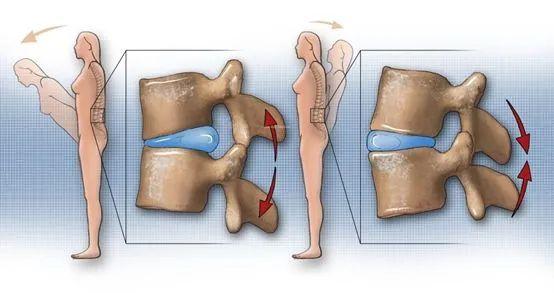 腰椎第四五节膨出图片图片