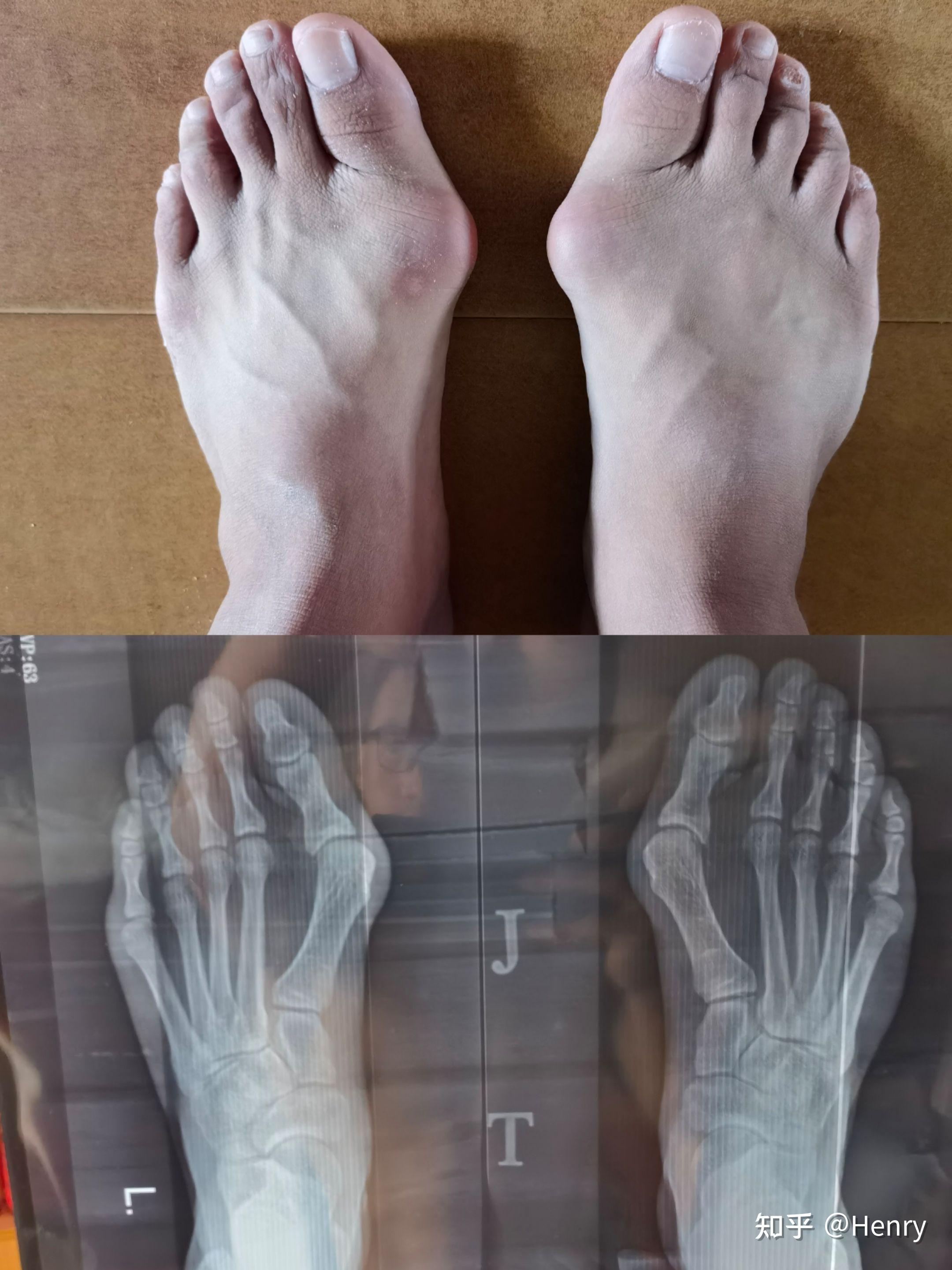 作为一个女生，脚拇指外翻是一种怎样的体验？ - 知乎