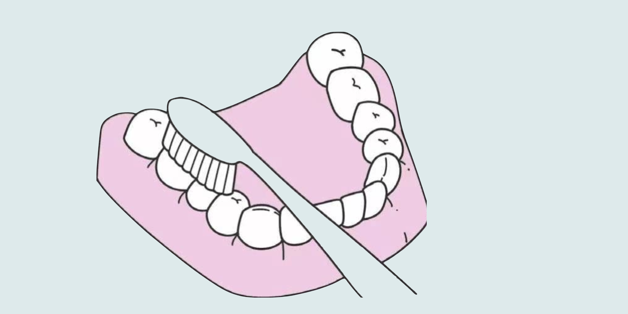 非常简单,直接用巴氏刷牙法,也叫水平颤动法,是目前世界上公认的有效