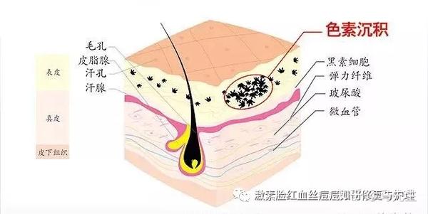 海英 什么是色素沉着 如何预防治 知乎