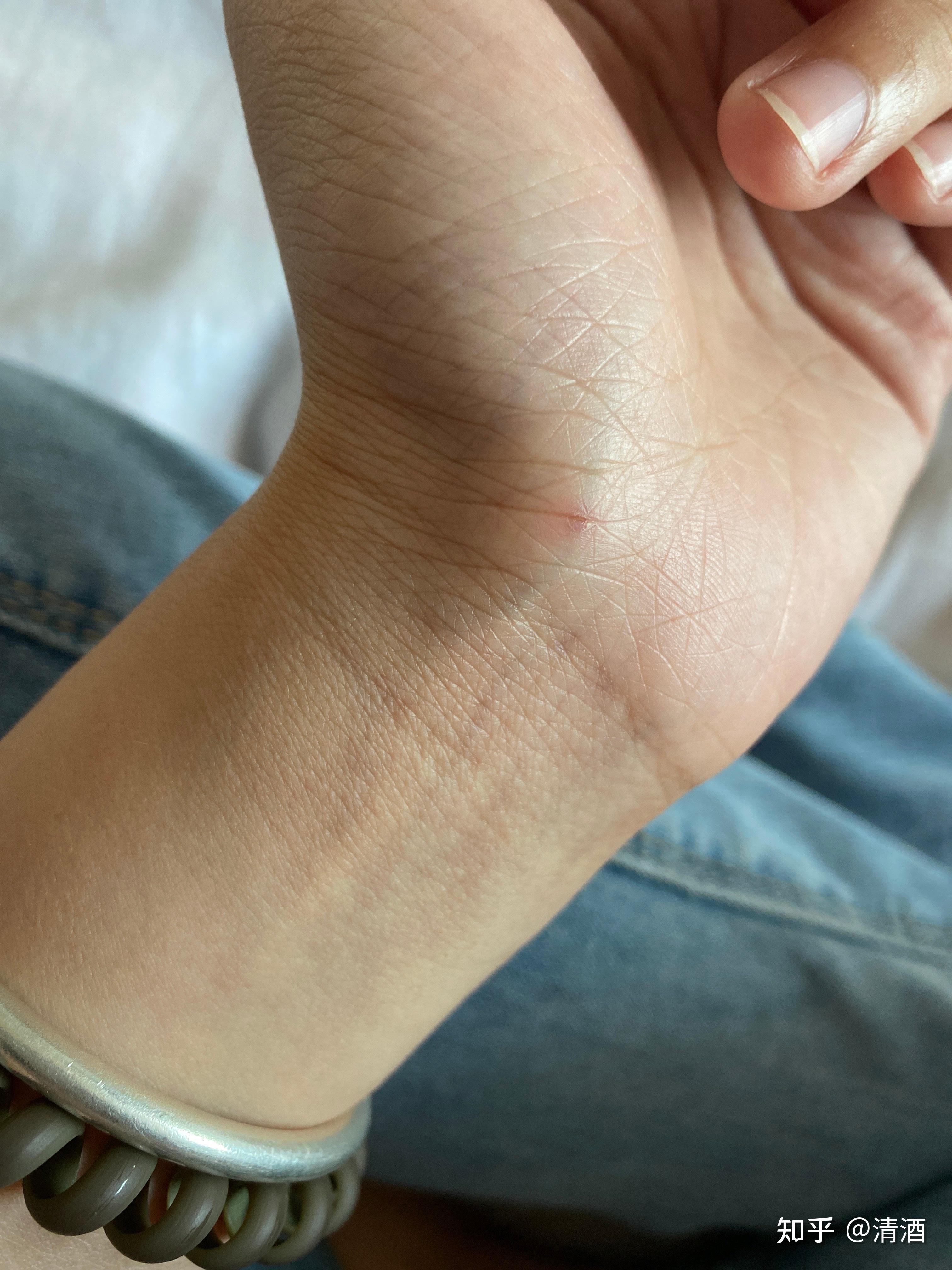 被刚出生几天的猫抓了一下轻微破皮