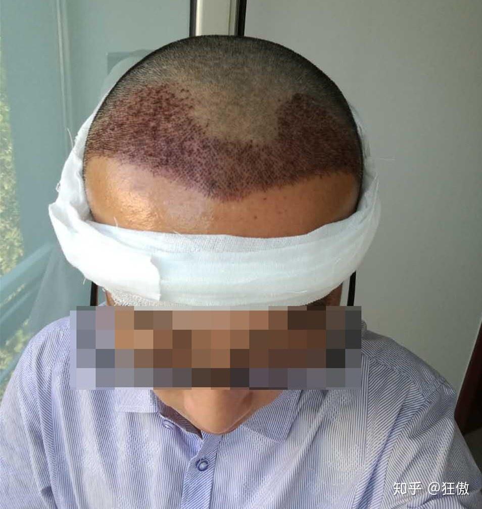 为什么秃顶的人这么多很少有做植发的?