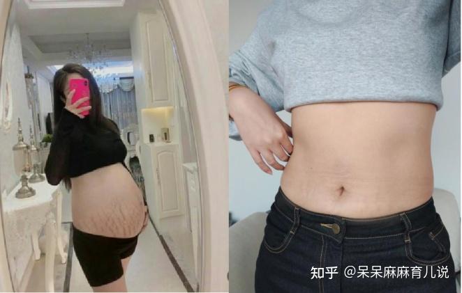 产后半年搞定妊娠纹 甩掉小肚腩，把握产后黄金期有效淡化妊娠纹 知乎