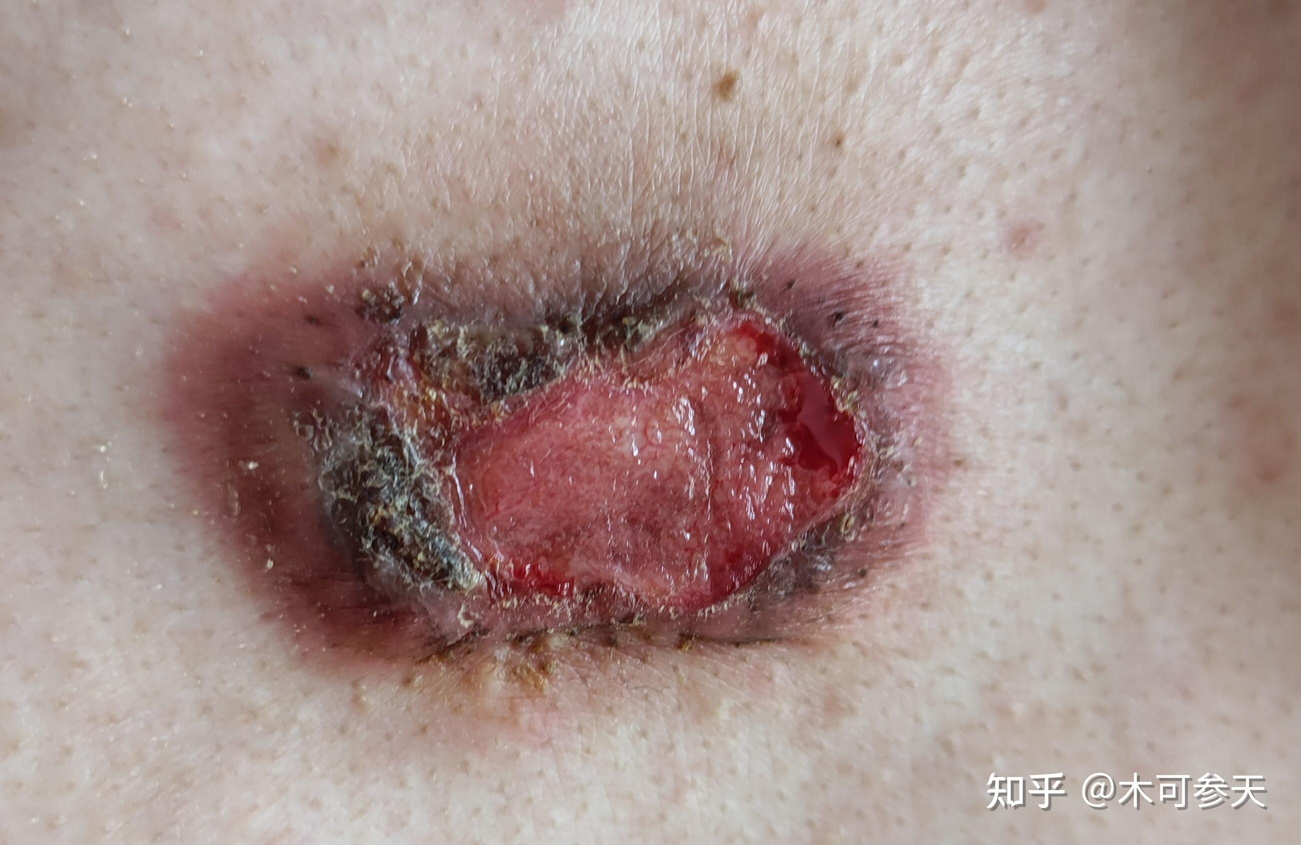 瘢痕疙瘩治疗历程心得写给正在烦恼的你供参考具体情况自己分析选择