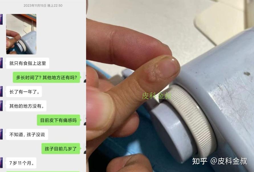 甲周疣甲下疣彻底好了恢复过程全记录合集