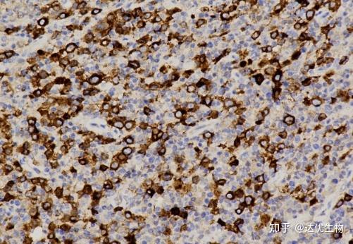 CD3、CD20…揭秘淋巴瘤免疫组化报告上的“CD家族” - 知乎